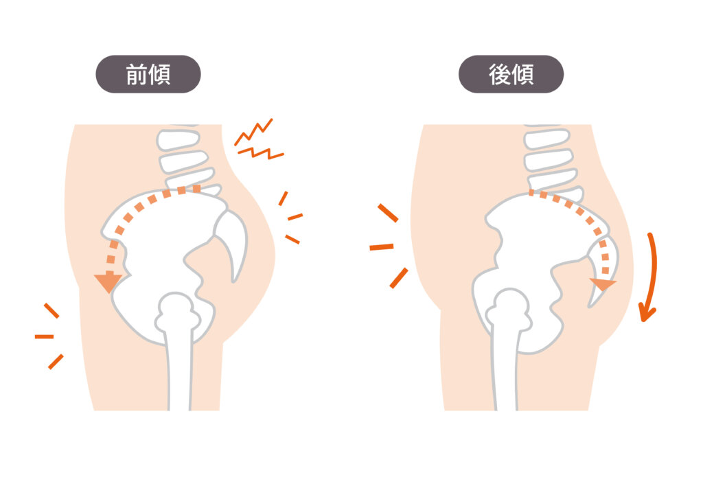 骨盤が前傾と後傾してる図